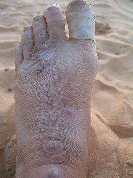 My lovely infected foot, on the road to Tomboctou