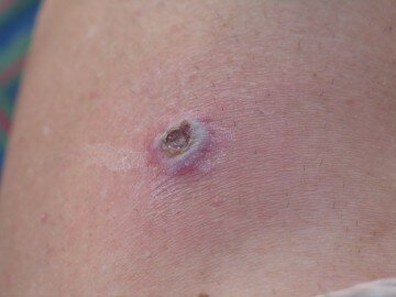 Infected prickle wound...there was a new one every day